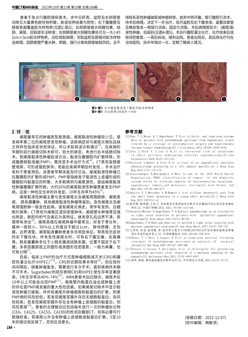 阑尾源性腹膜假黏液瘤误诊为阑尾炎1例.pdf_第2页