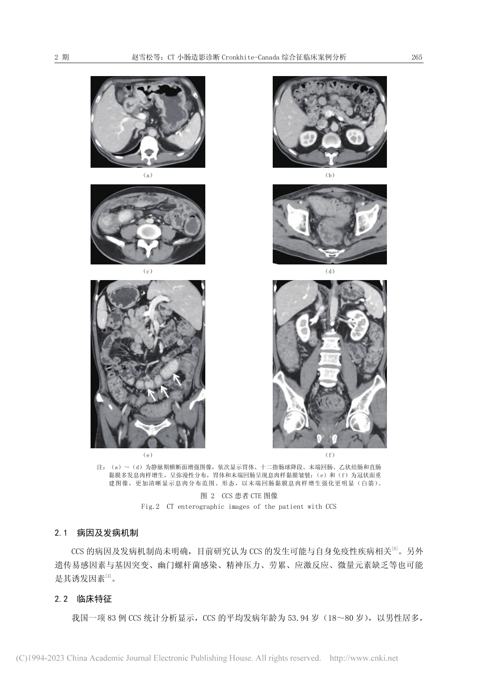 CT小肠造影诊断Cronk...nada综合征临床案例分析_赵雪松.pdf_第3页