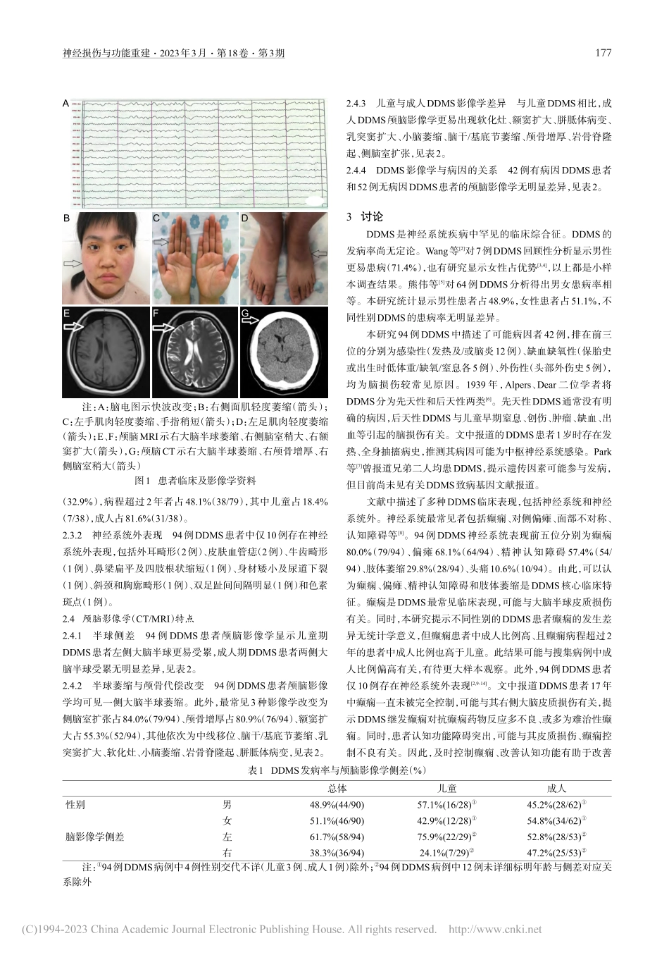 Dyke-Davidoff...n综合征的临床与影像学特征_朱凌.pdf_第2页