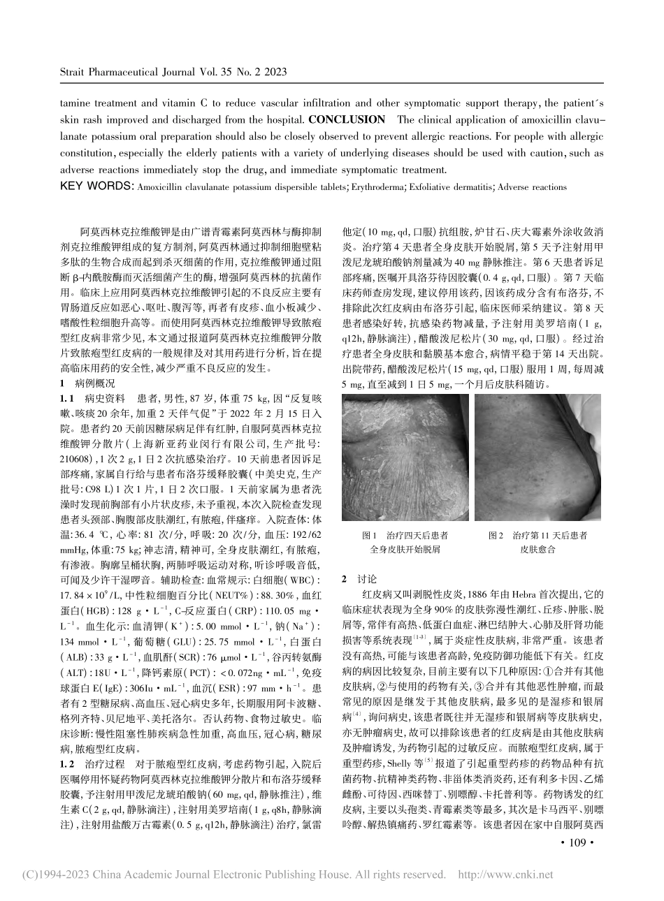 阿莫西林克拉维酸钾致脓疱型红皮病1例及药学监护_刘敏.pdf_第2页