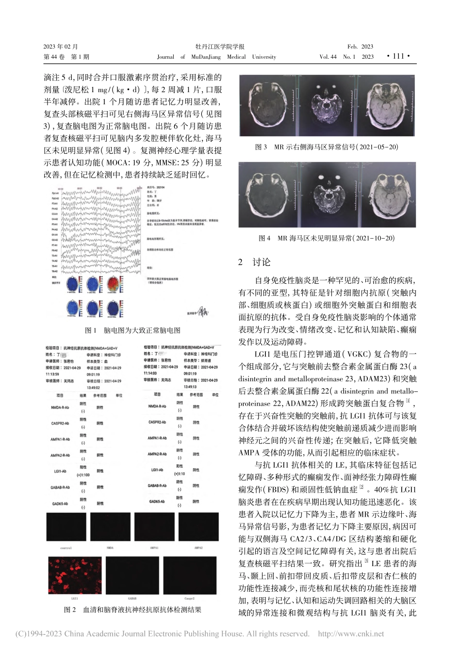 抗LGI-1抗体阳性边缘叶脑炎1例_徐明蔚.pdf_第2页
