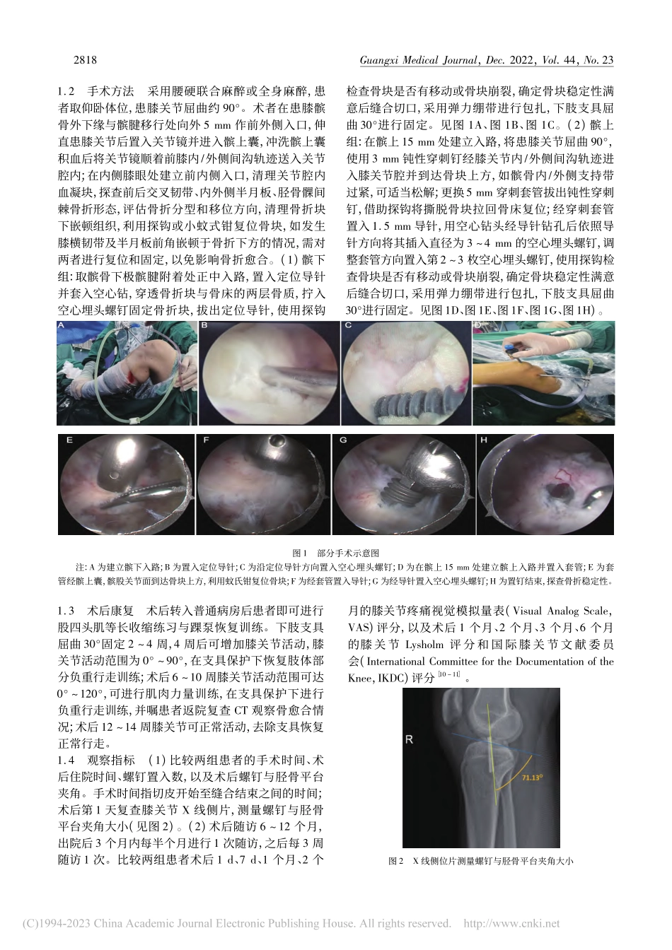 经髌下入路与经髌上入路关节...髁间棘闭合性骨折的疗效比较_李晓.pdf_第2页