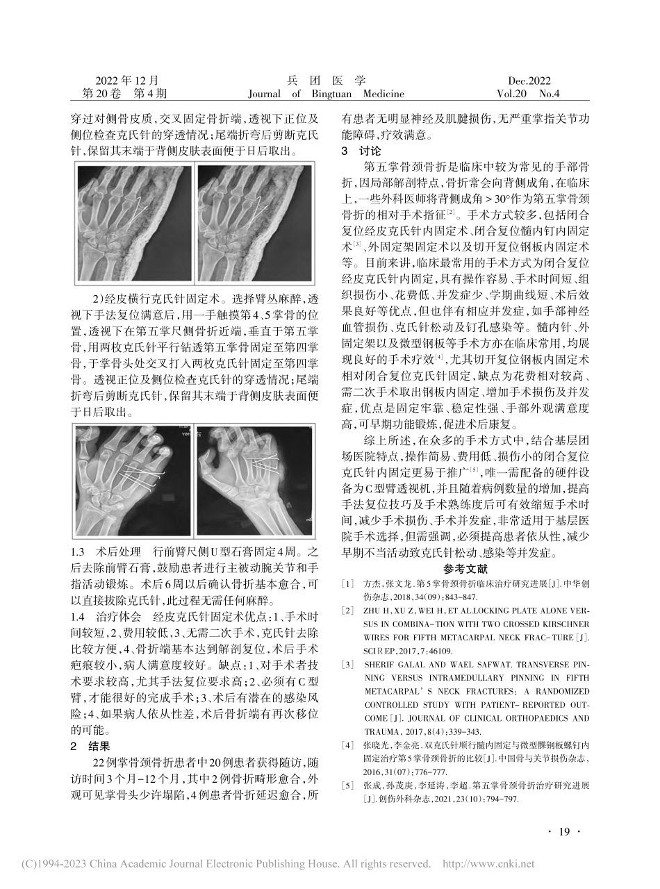 经皮克氏针内固定治疗第五掌骨颈骨折的体会_余剑锋.pdf_第2页