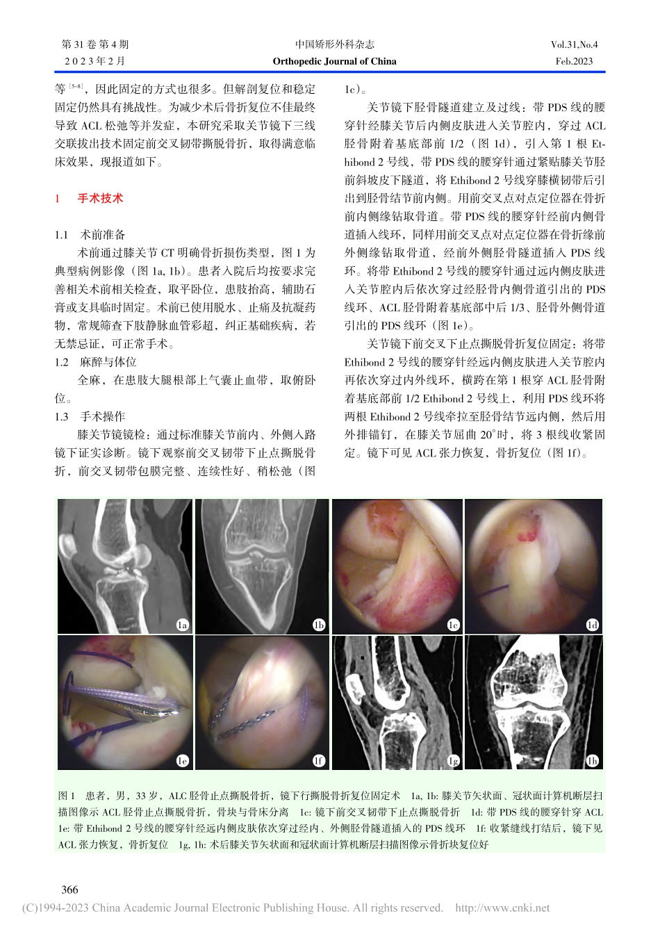 镜下三线交联拉出固定前交叉韧带胫骨止点撕脱骨折_王一仲.pdf_第2页