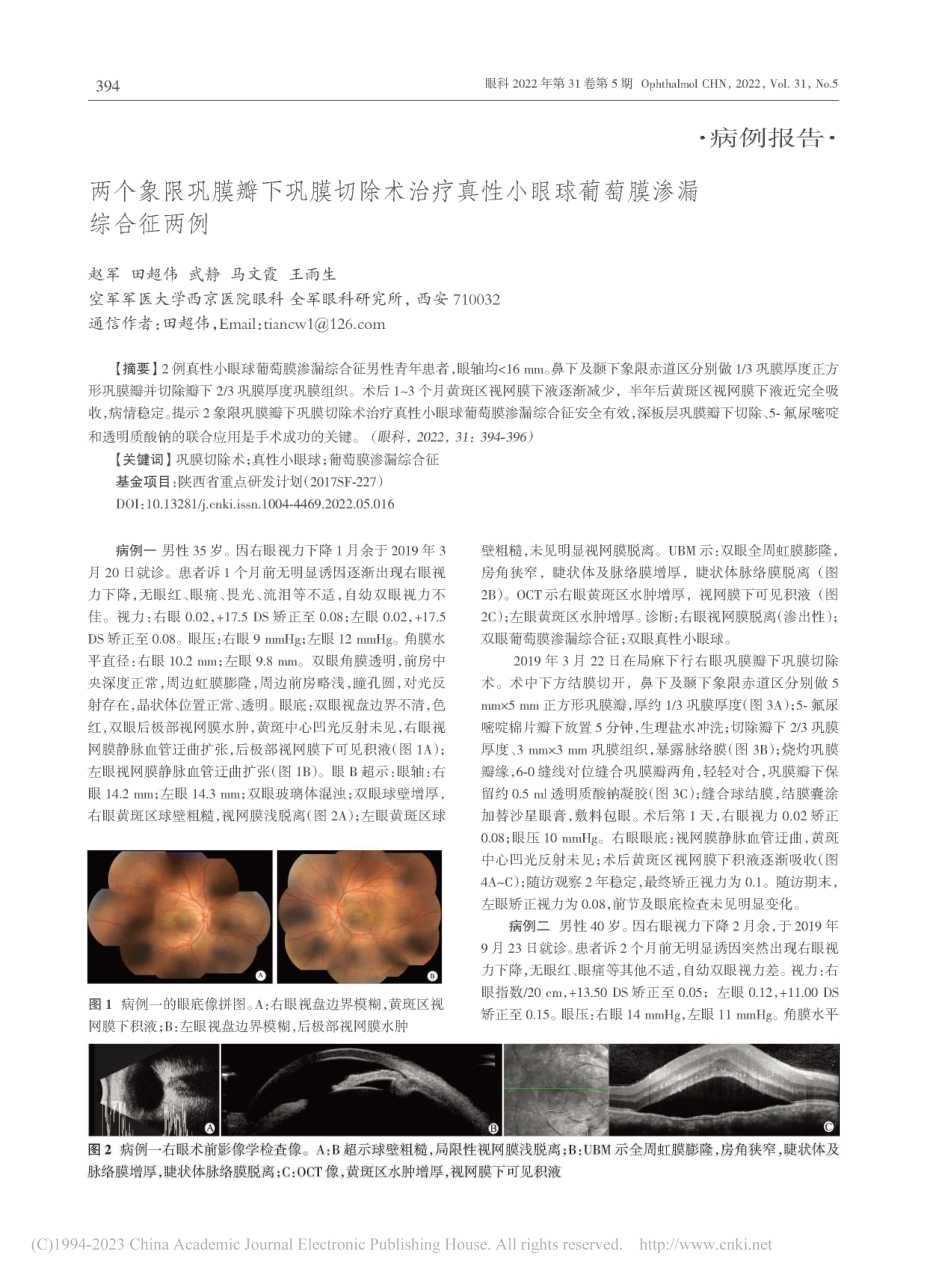 两个象限巩膜瓣下巩膜切除术...小眼球葡萄膜渗漏综合征两例_赵军.pdf_第1页