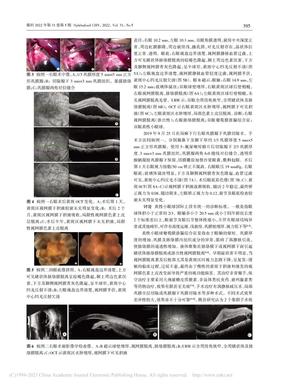 两个象限巩膜瓣下巩膜切除术...小眼球葡萄膜渗漏综合征两例_赵军.pdf_第2页