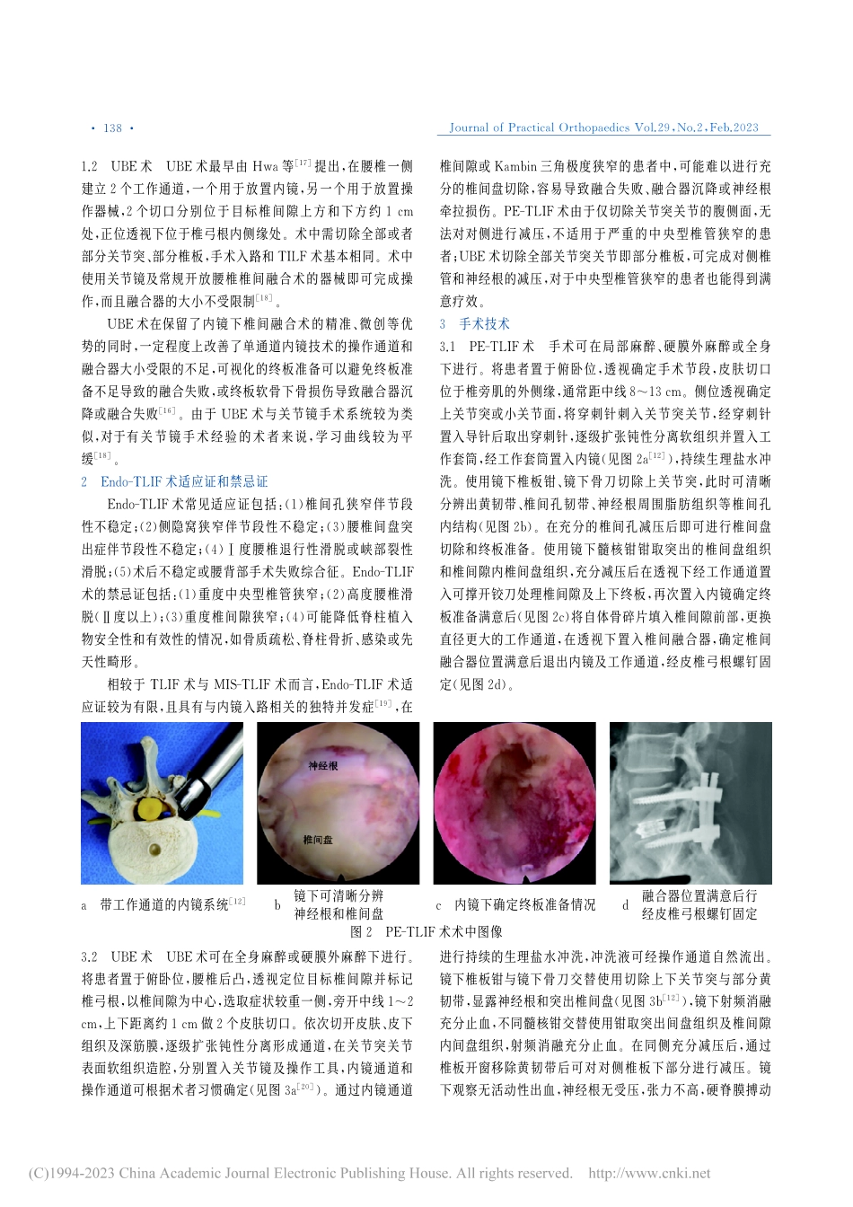 内镜下经椎间孔入路腰椎椎间融合术的研究进展_张博程.pdf_第2页