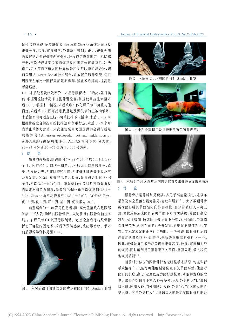 内侧撑开技术辅助跗骨窦切口...型、Ⅲ型骨折的临床疗效分析_侯建伟.pdf_第2页