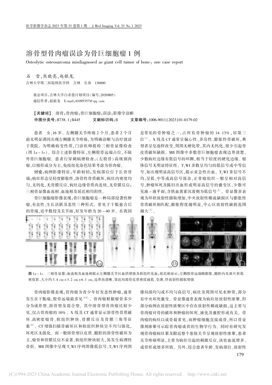溶骨型骨肉瘤误诊为骨巨细胞瘤1例_石雪.pdf_第1页