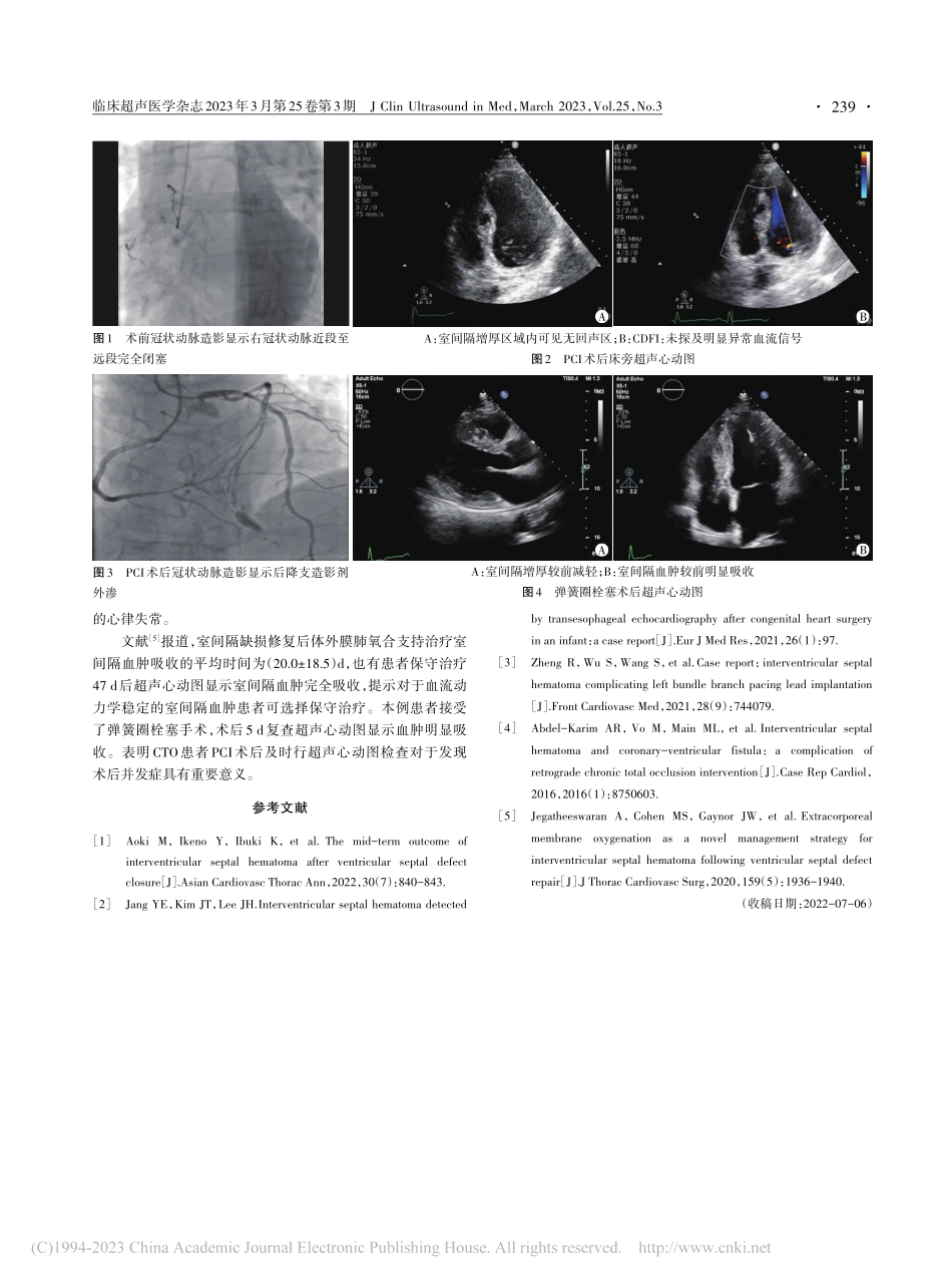 超声心动图诊断右冠状动脉慢...动脉介入术后室间隔血肿1例_刘家佳.pdf_第2页