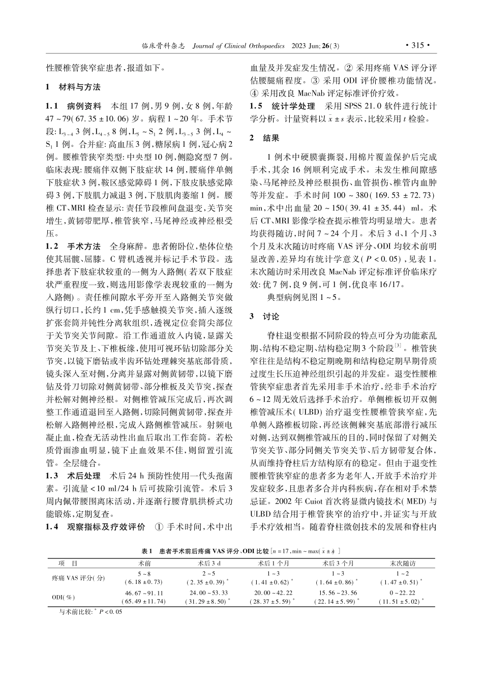 大通道全内镜下单侧入路双侧...减压治疗退变性腰椎管狭窄症_张明赳.pdf_第2页