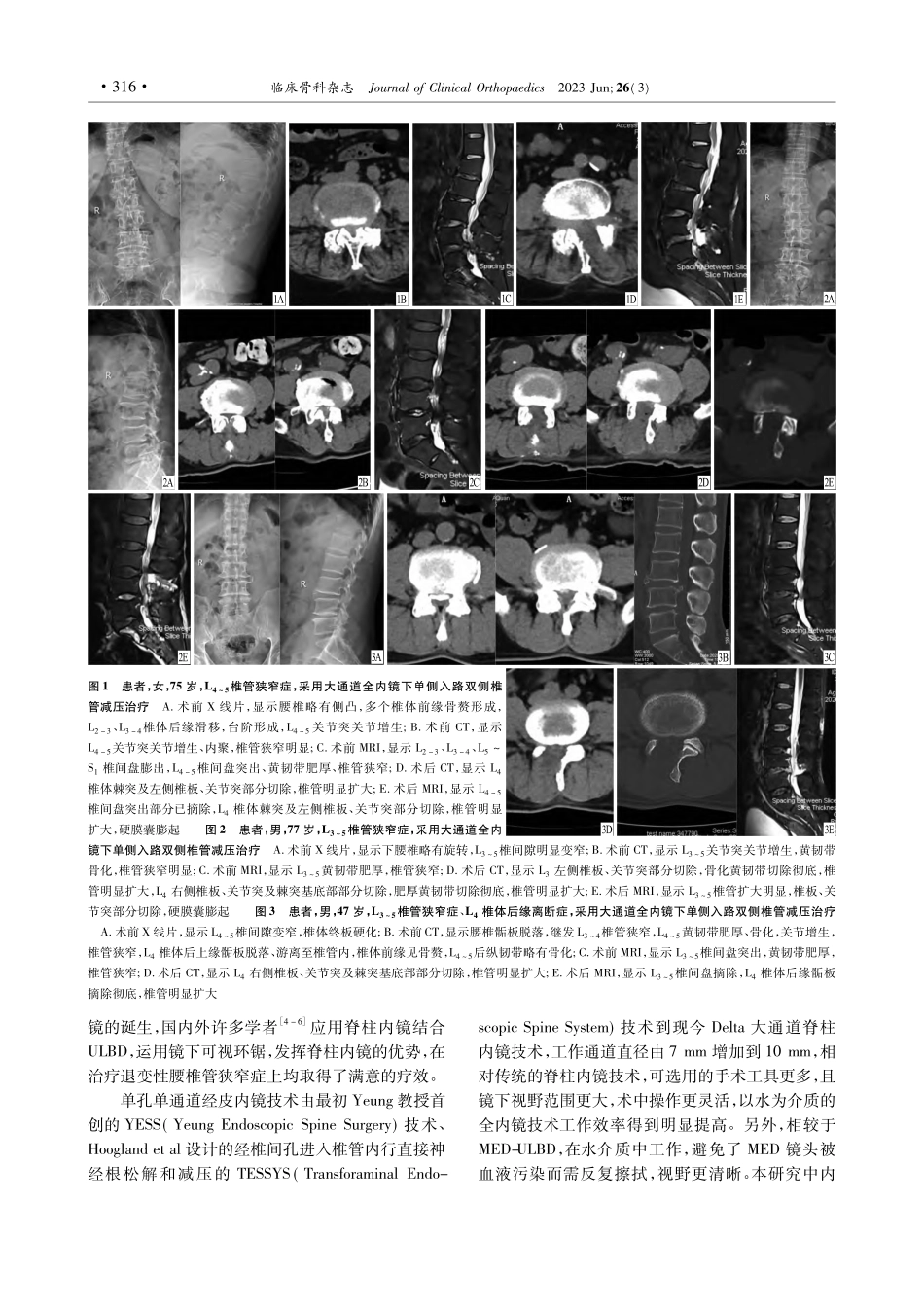 大通道全内镜下单侧入路双侧...减压治疗退变性腰椎管狭窄症_张明赳.pdf_第3页