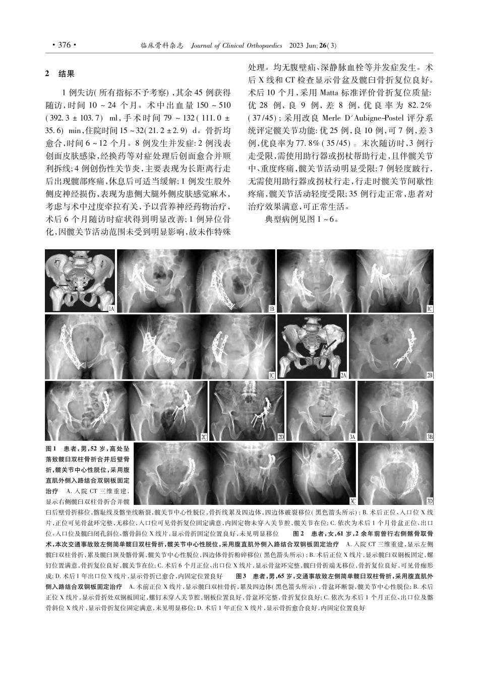 腹直肌外侧入路双钢板固定治疗累及四边体的髋臼双柱骨折_谢盼盼.pdf_第3页