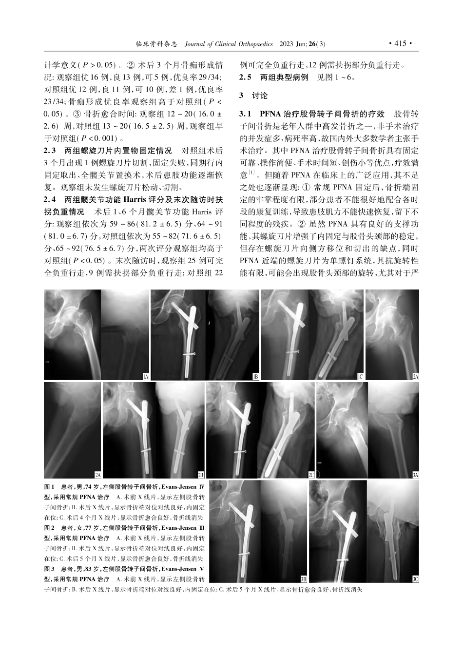 股骨近端防旋髓内钉联合骨水...强化治疗老年股骨转子间骨折_白尚.pdf_第3页