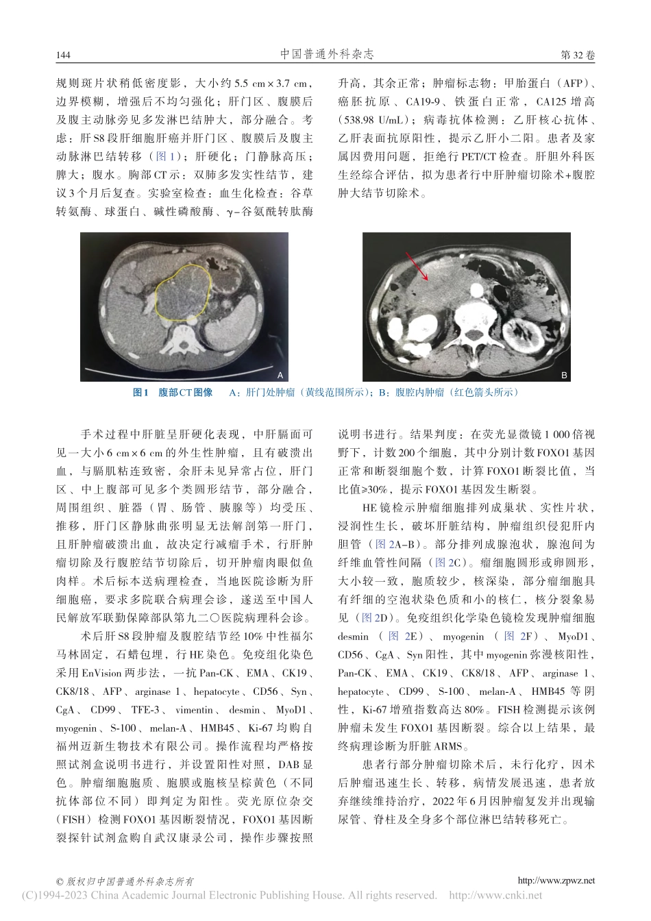 成人肝脏腺泡状横纹肌肉瘤1例并文献复习_江亚.pdf_第2页