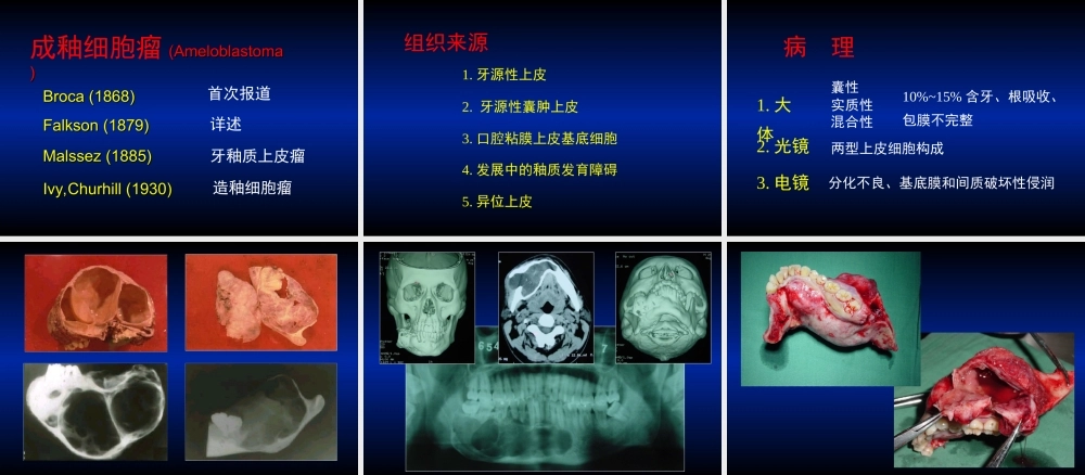 14 肿瘤3.ppt