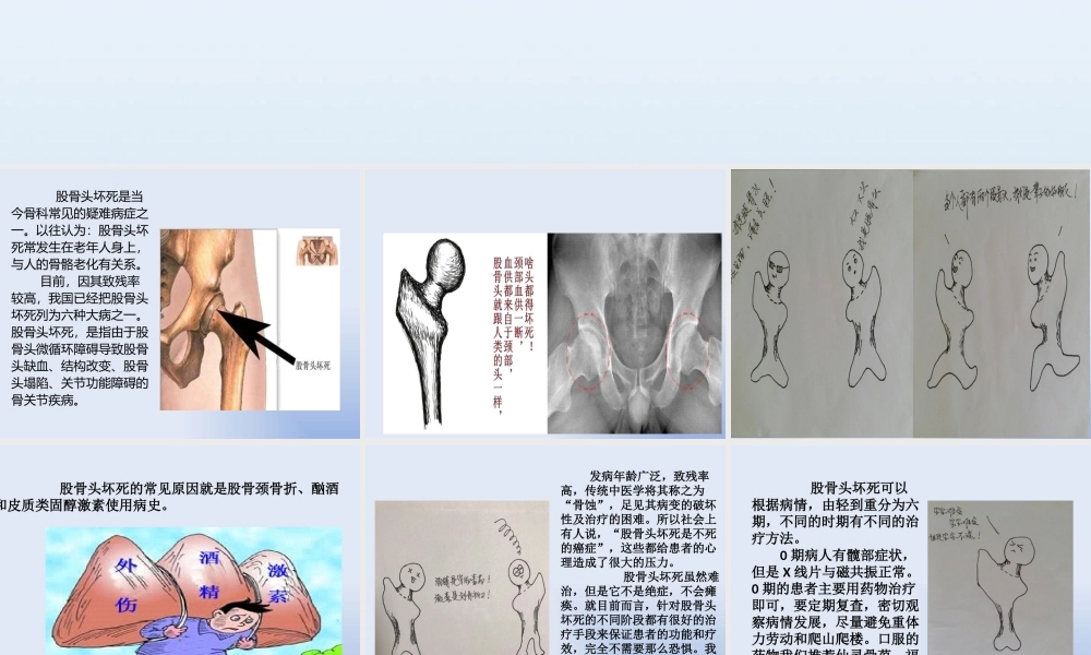 097、浅谈股骨头坏死.pptx