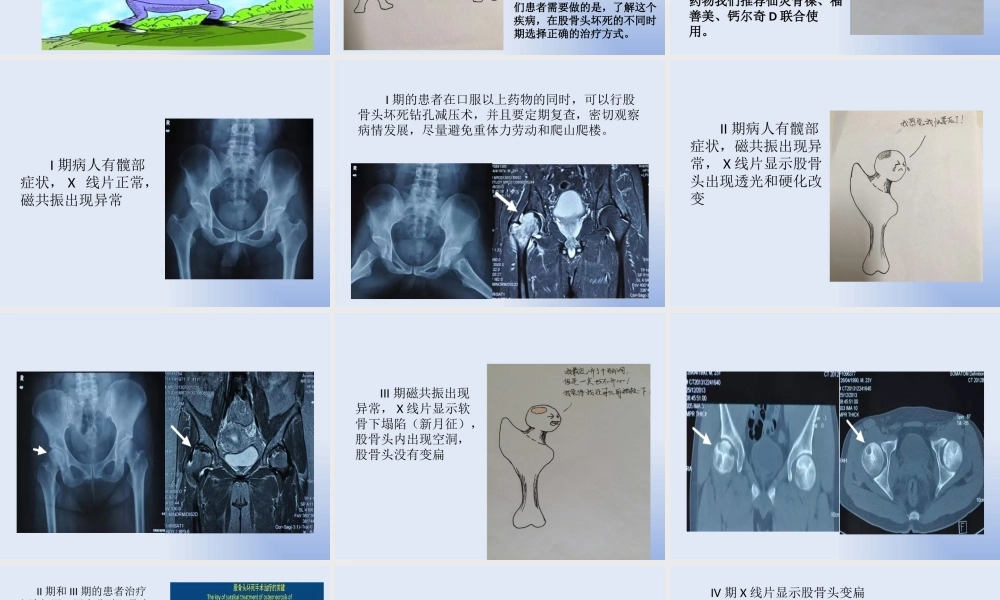 097、浅谈股骨头坏死.pptx