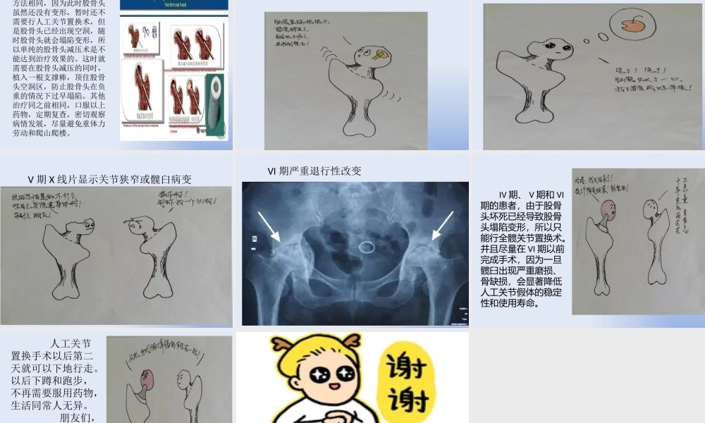 097、浅谈股骨头坏死.pptx