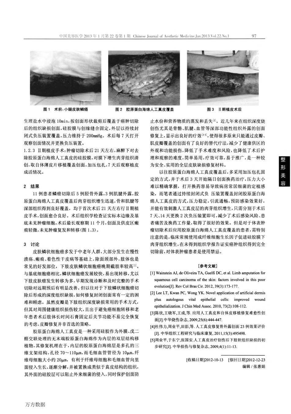 (皮耐克）胶原蛋白海绵人工真皮在皮肤鳞状细胞癌创面修复中的应用.pdf_第2页