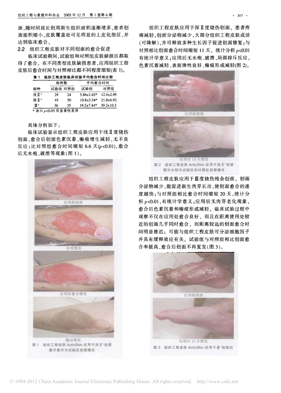 组织工程皮肤加速烧烫伤皮肤创面愈合的多中心临床研究_聂鑫权.pdf_第3页