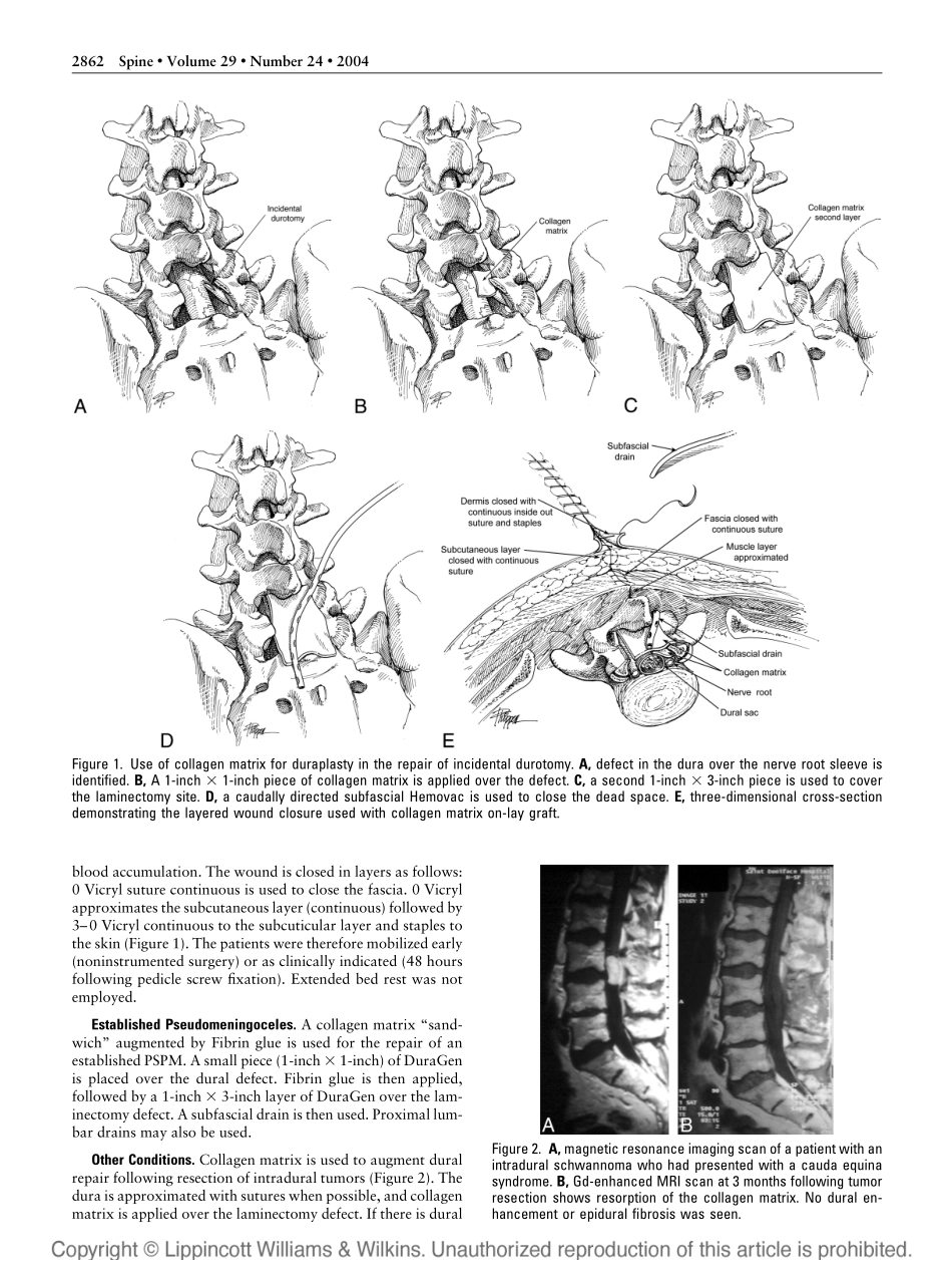 胶原蛋白海绵在硬脊膜修复：分析新型改量技术原文.pdf_第2页