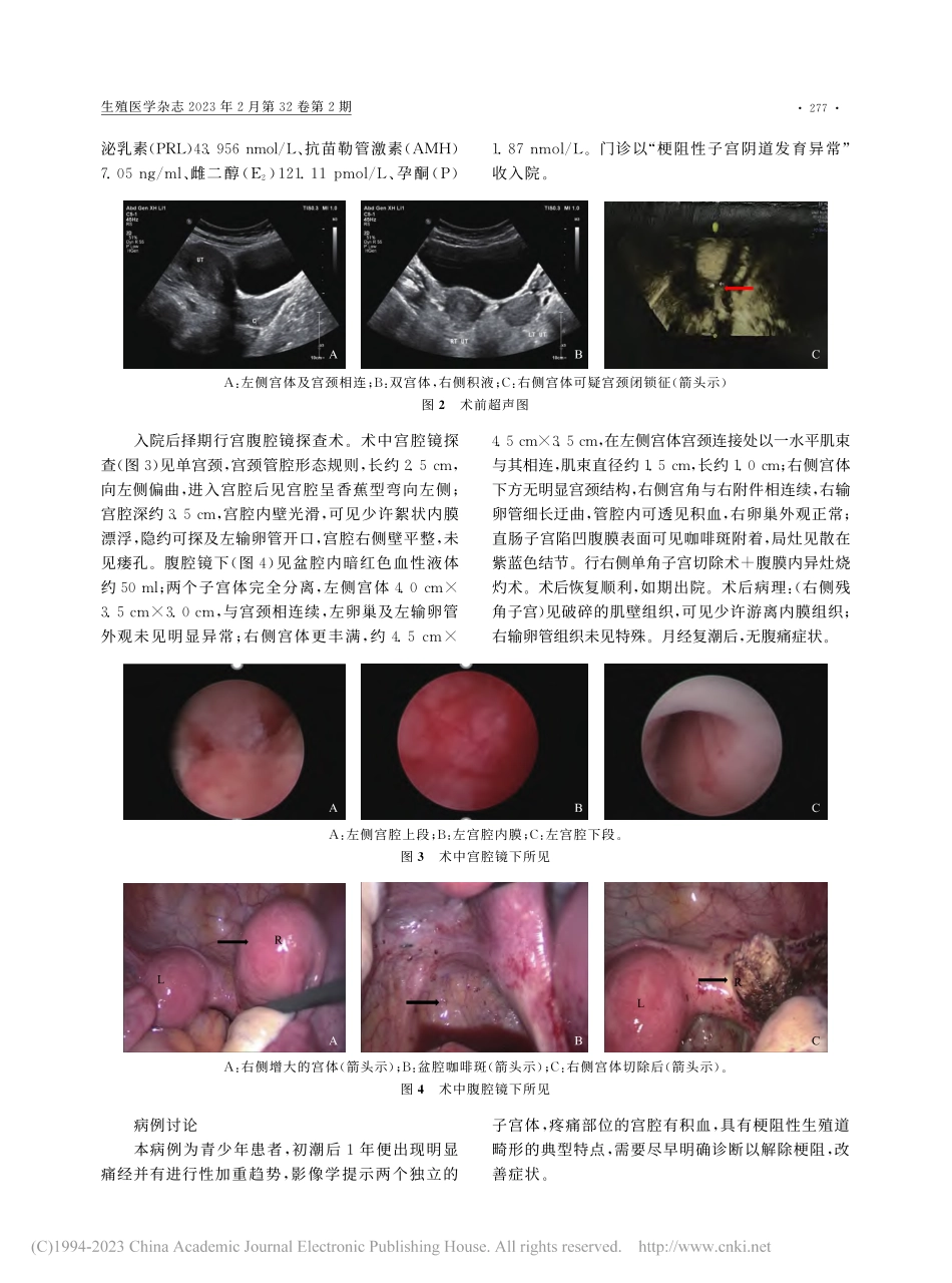 单角子宫抑或四型斜隔综合征1例_夏萍.pdf_第2页