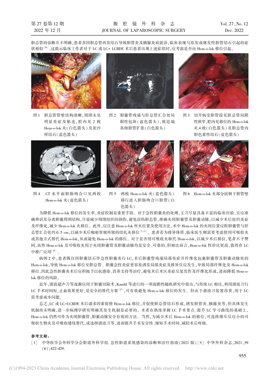 胆囊切除术后Hem-o-lok夹胆管移位3例报告_付振东.pdf_第2页