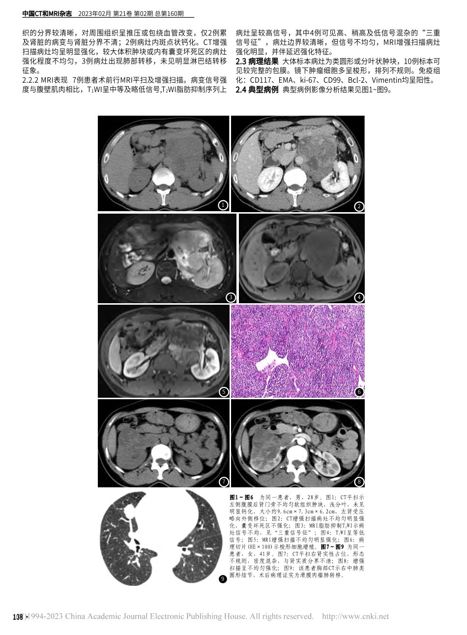 腹盆部滑膜肉瘤的CT、MRI表现与临床病理分析_皮厚山.pdf_第2页