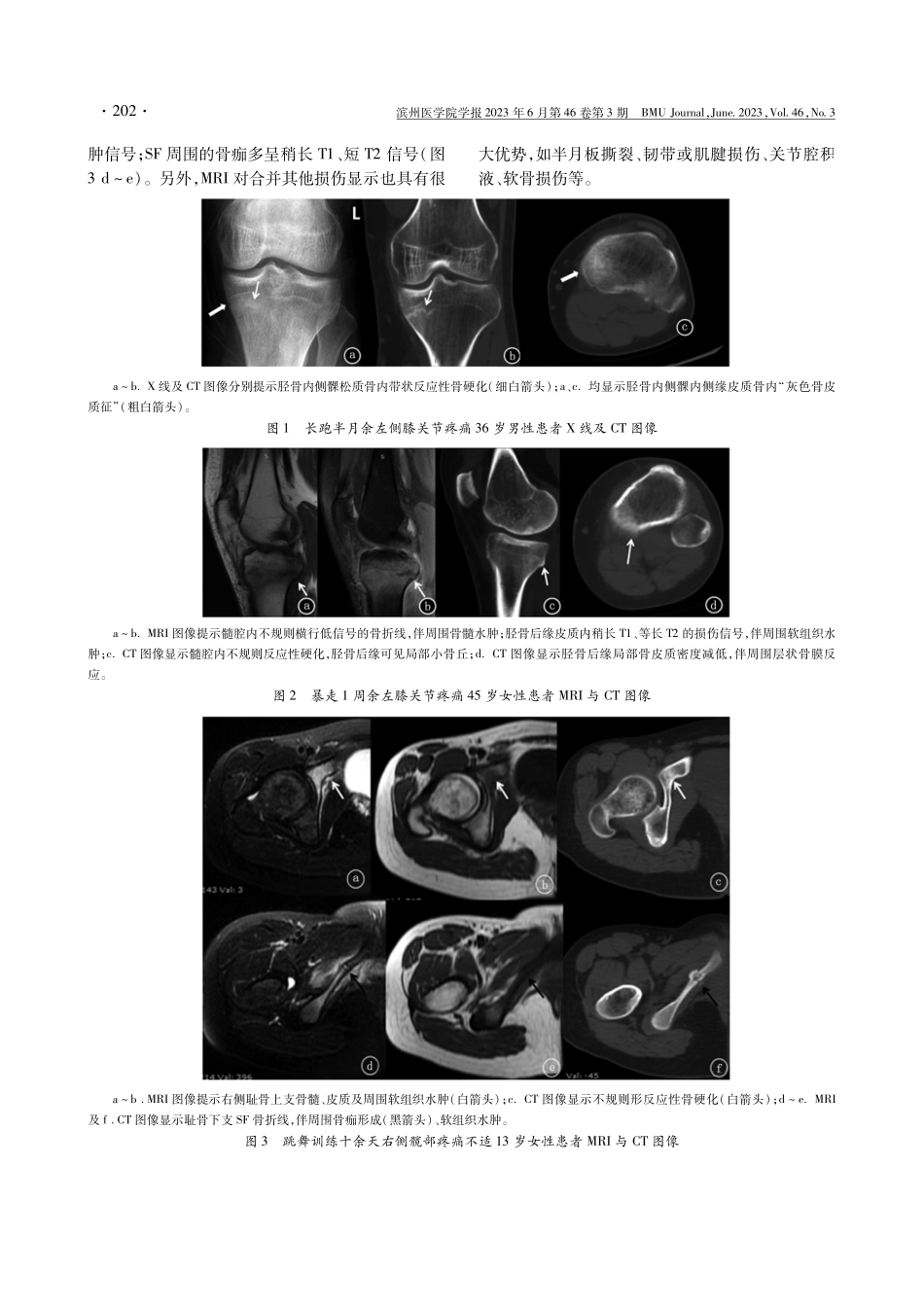 79例城镇居民应力性骨折的影像学特点.pdf_第3页