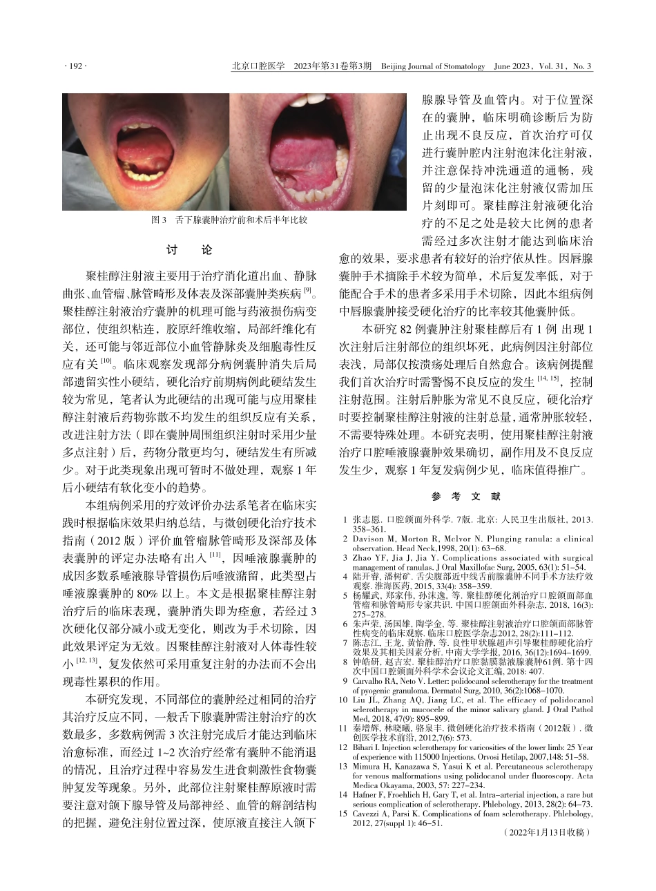 聚桂醇注射液治疗口腔唾液腺黏液囊肿的临床观察_肖玉霞.pdf_第3页