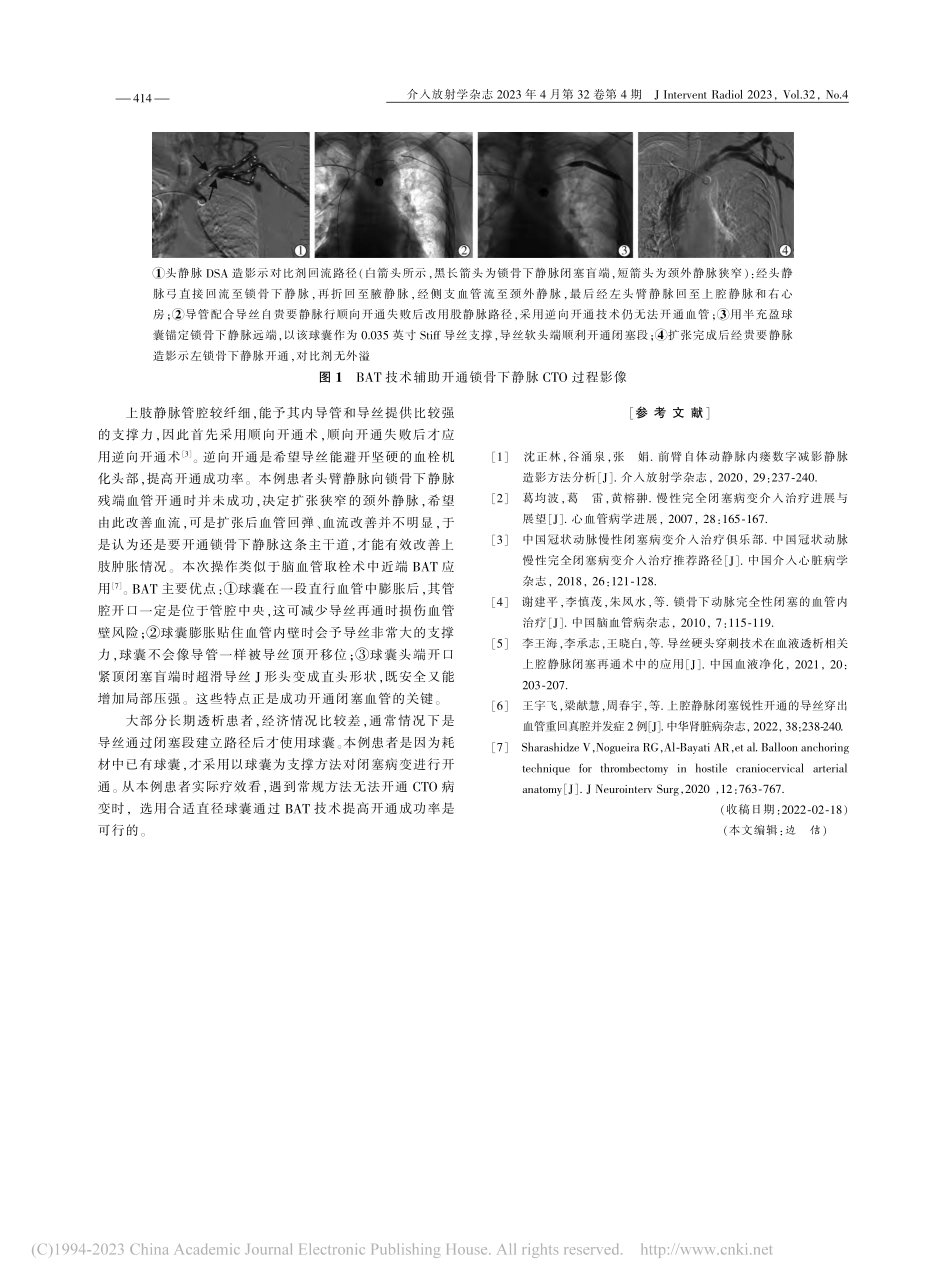 球囊锚定技术辅助开通锁骨下静脉闭塞1例_沈正林.pdf_第2页
