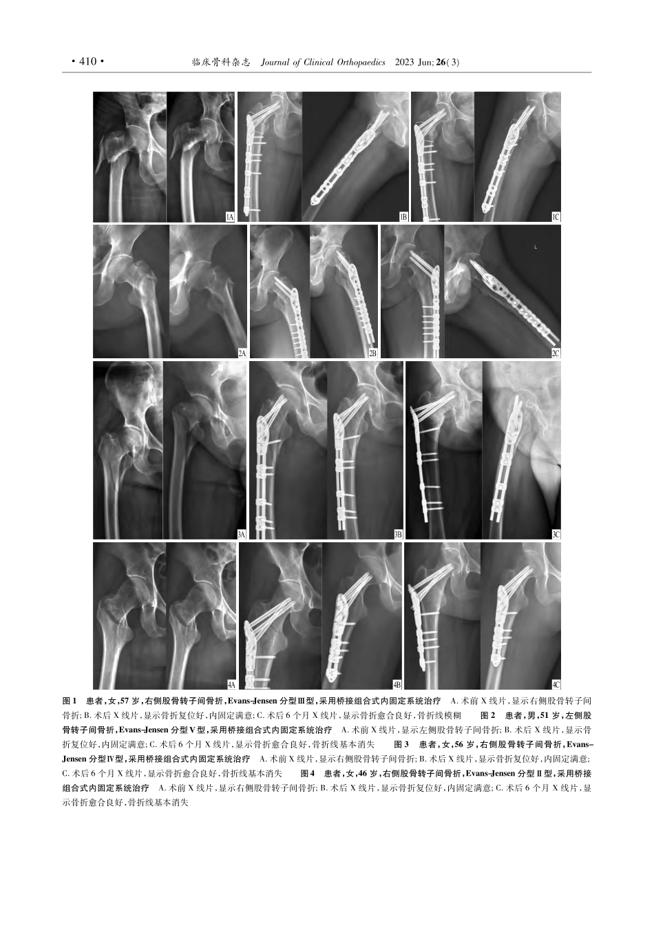 桥接组合式内固定系统治疗股骨转子间骨折_戴厚杰.pdf_第3页
