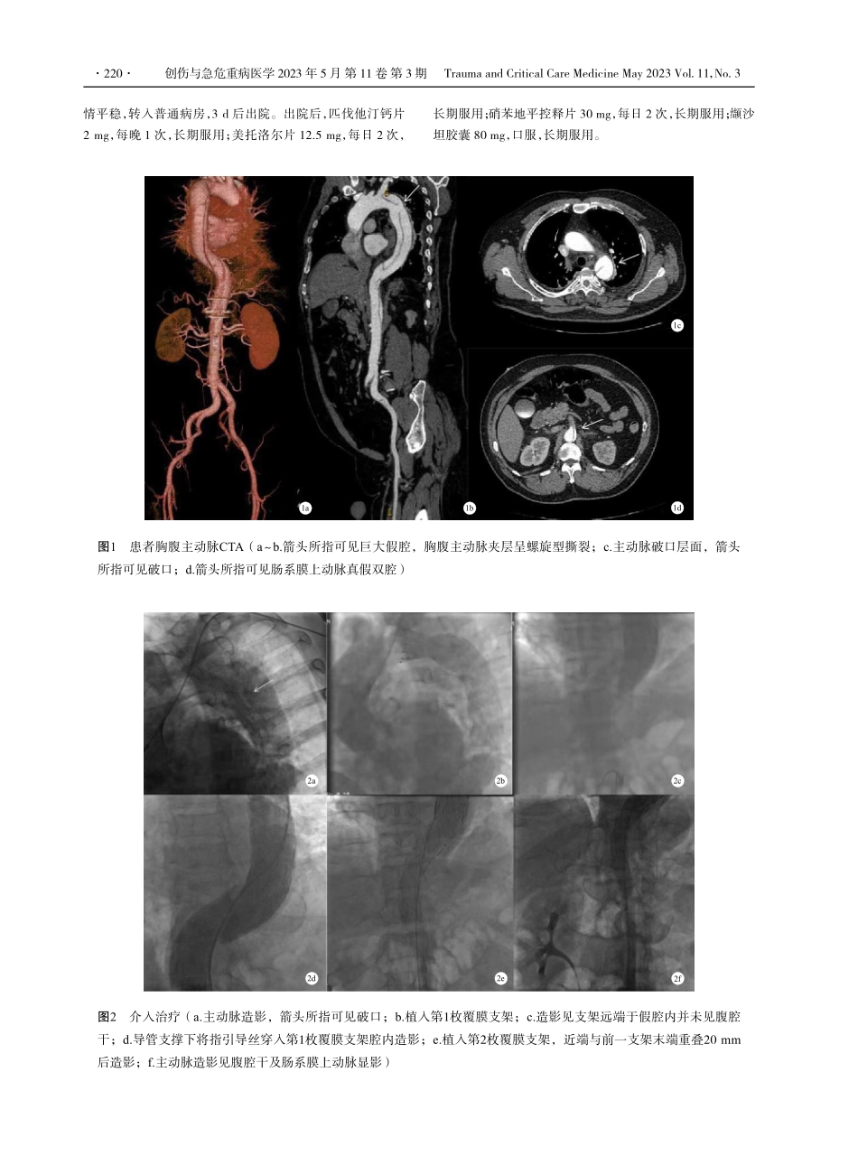 急性Stanford B型主动脉夹层覆膜支架植入假腔后重回真腔再连支架1例.pdf_第2页