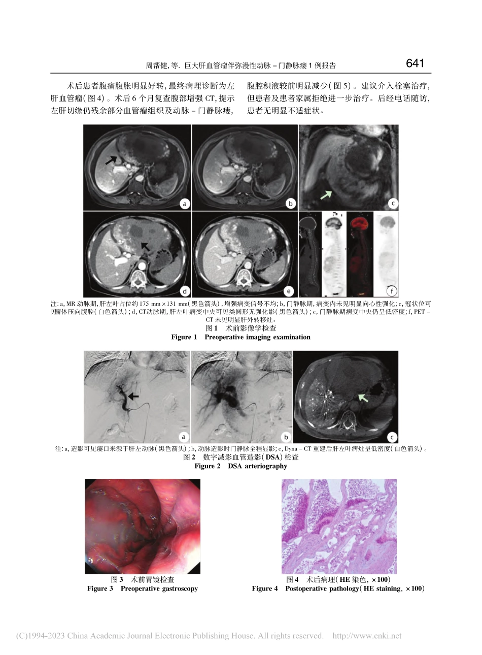 巨大肝血管瘤伴弥漫性动脉-门静脉瘘1例报告_周帮健.pdf_第2页
