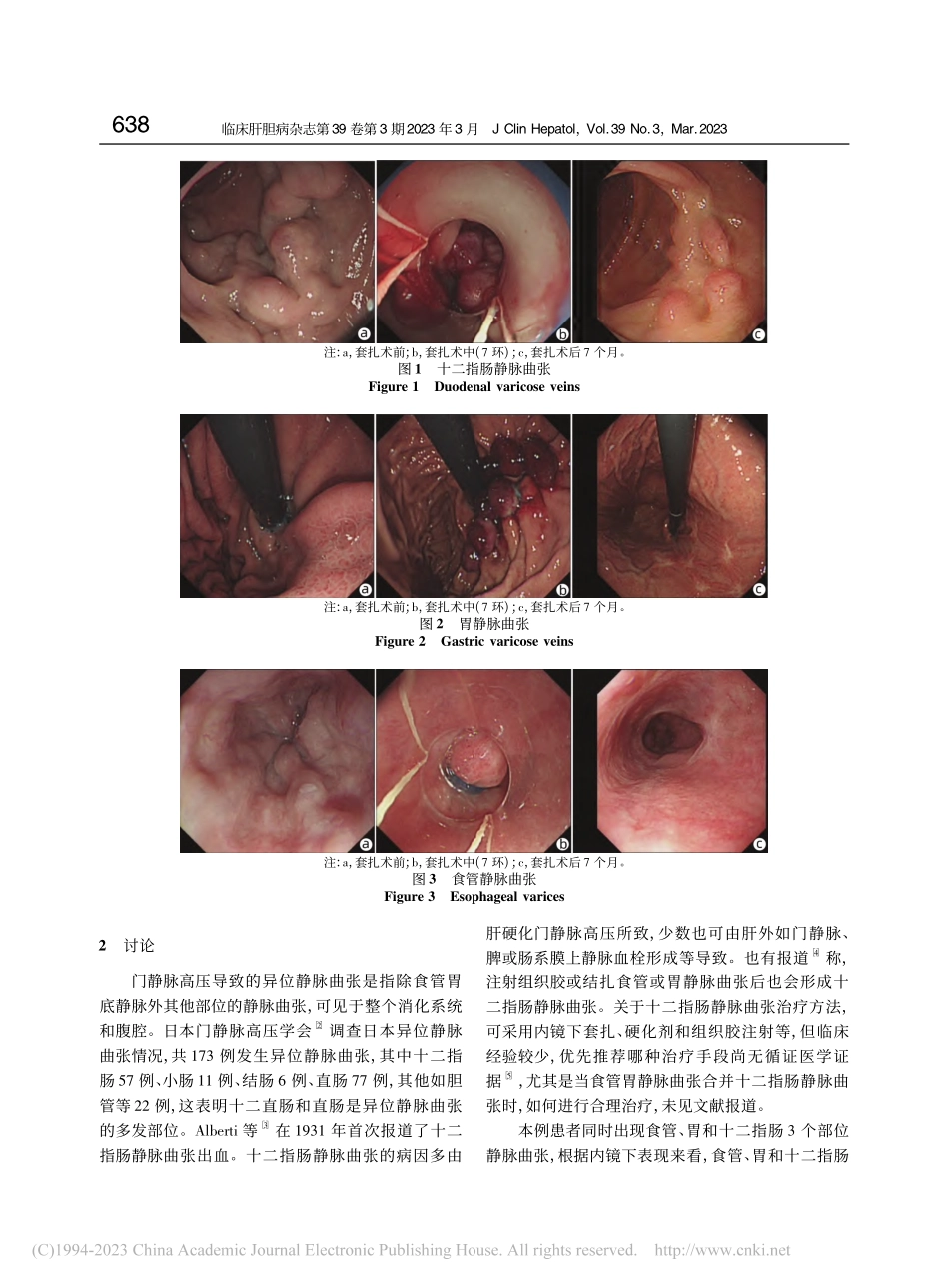 内镜下序贯套扎治疗食管胃伴十二指肠静脉曲张1例报告_文皓.pdf_第2页