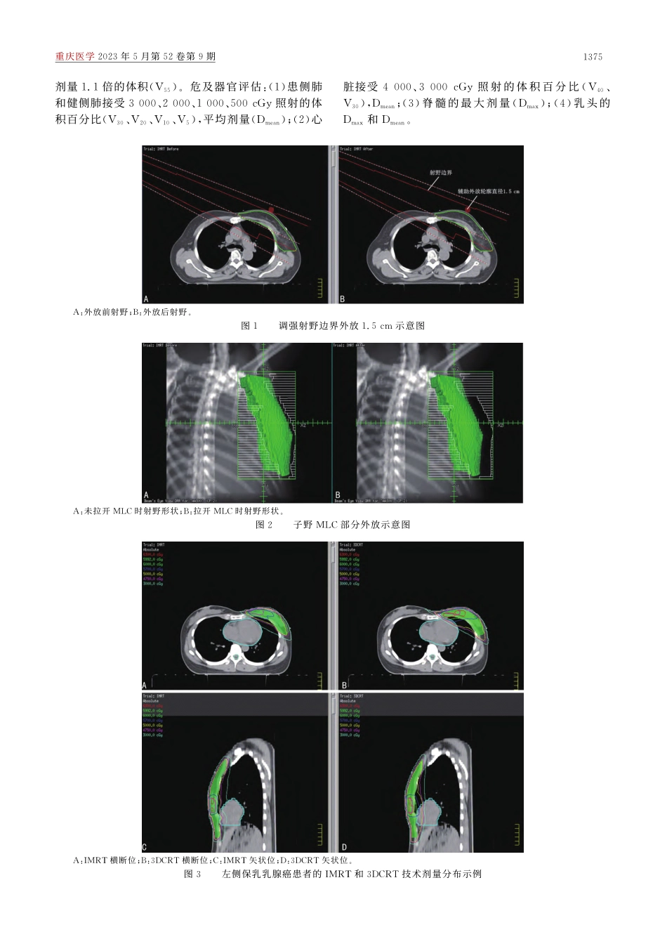 乳腺癌保乳术后IMRT和3DCRT的剂量学比较_董晓庆.pdf_第3页