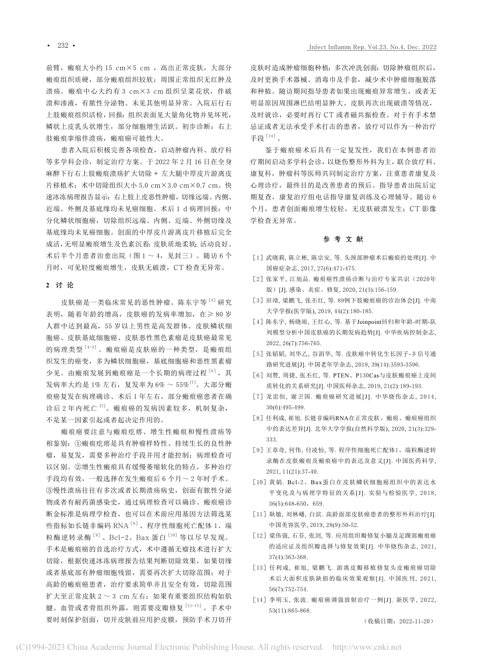 乳头型瘢痕癌患者多学科合作治疗1例_韩志新.pdf_第2页