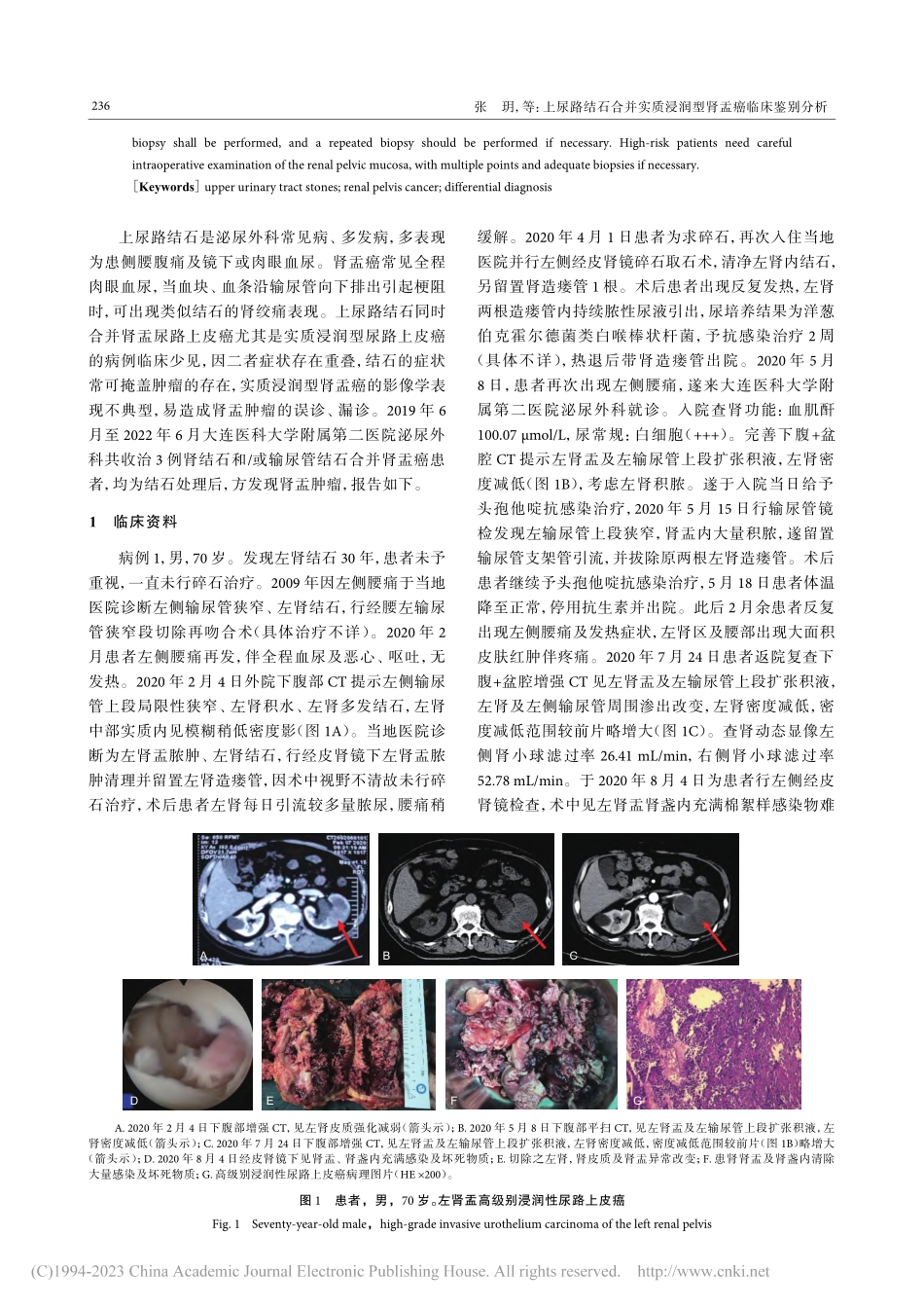 上尿路结石合并实质浸润型肾盂癌临床鉴别分析_张玥.pdf_第2页