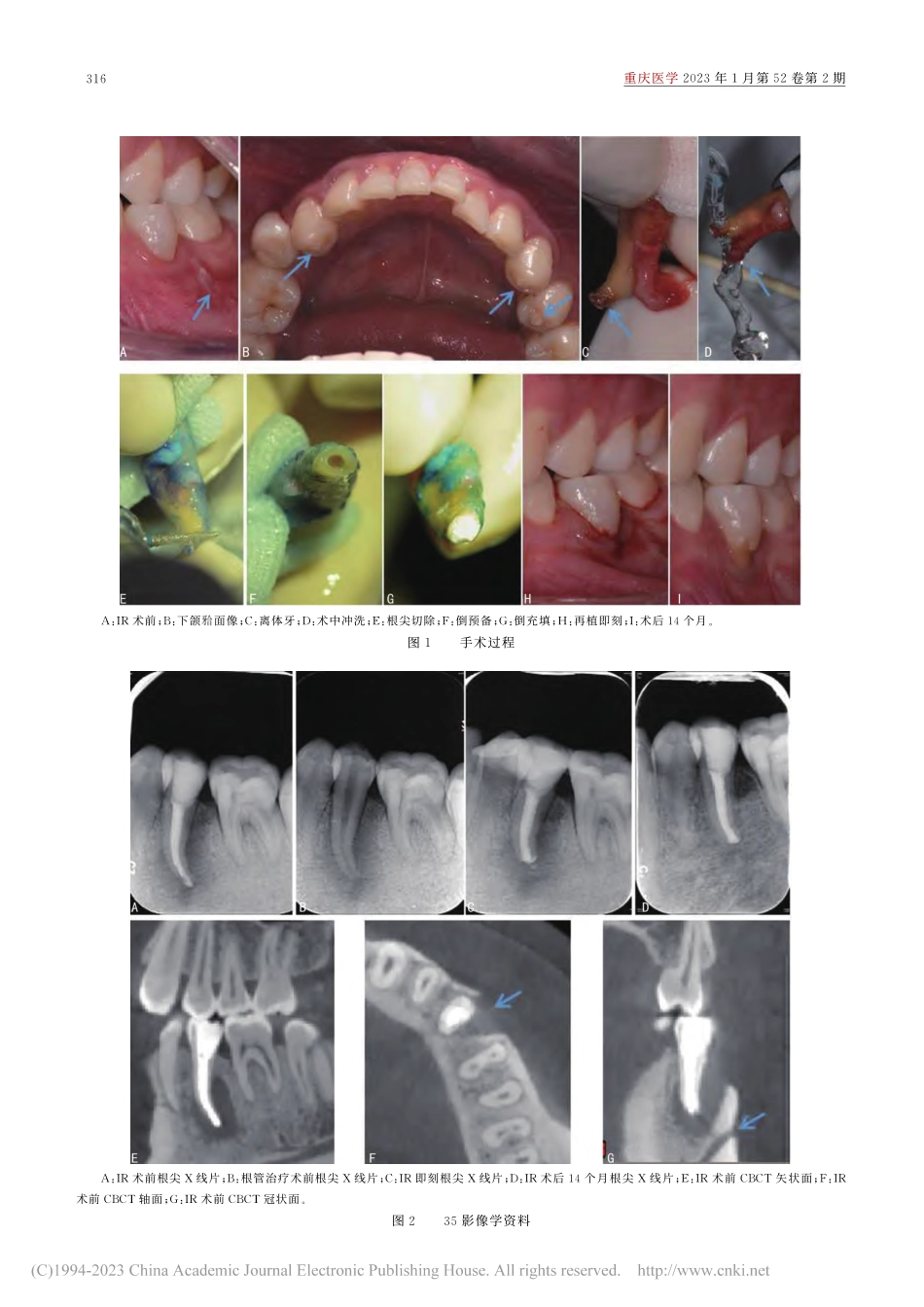 意向性牙再植术治疗左下第二前磨牙慢性根尖周炎1例_孙琼.pdf_第2页