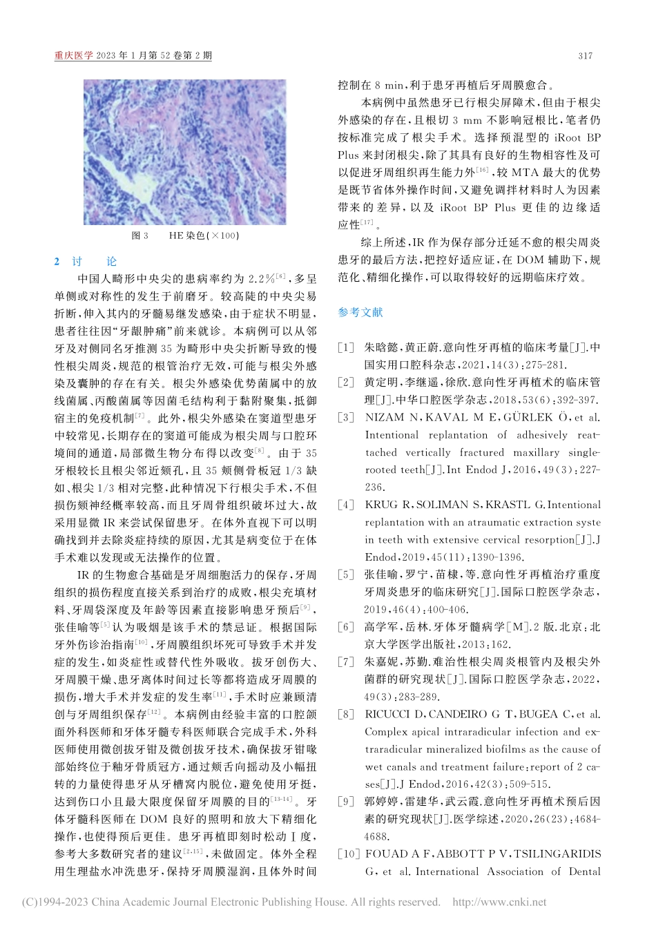 意向性牙再植术治疗左下第二前磨牙慢性根尖周炎1例_孙琼.pdf_第3页