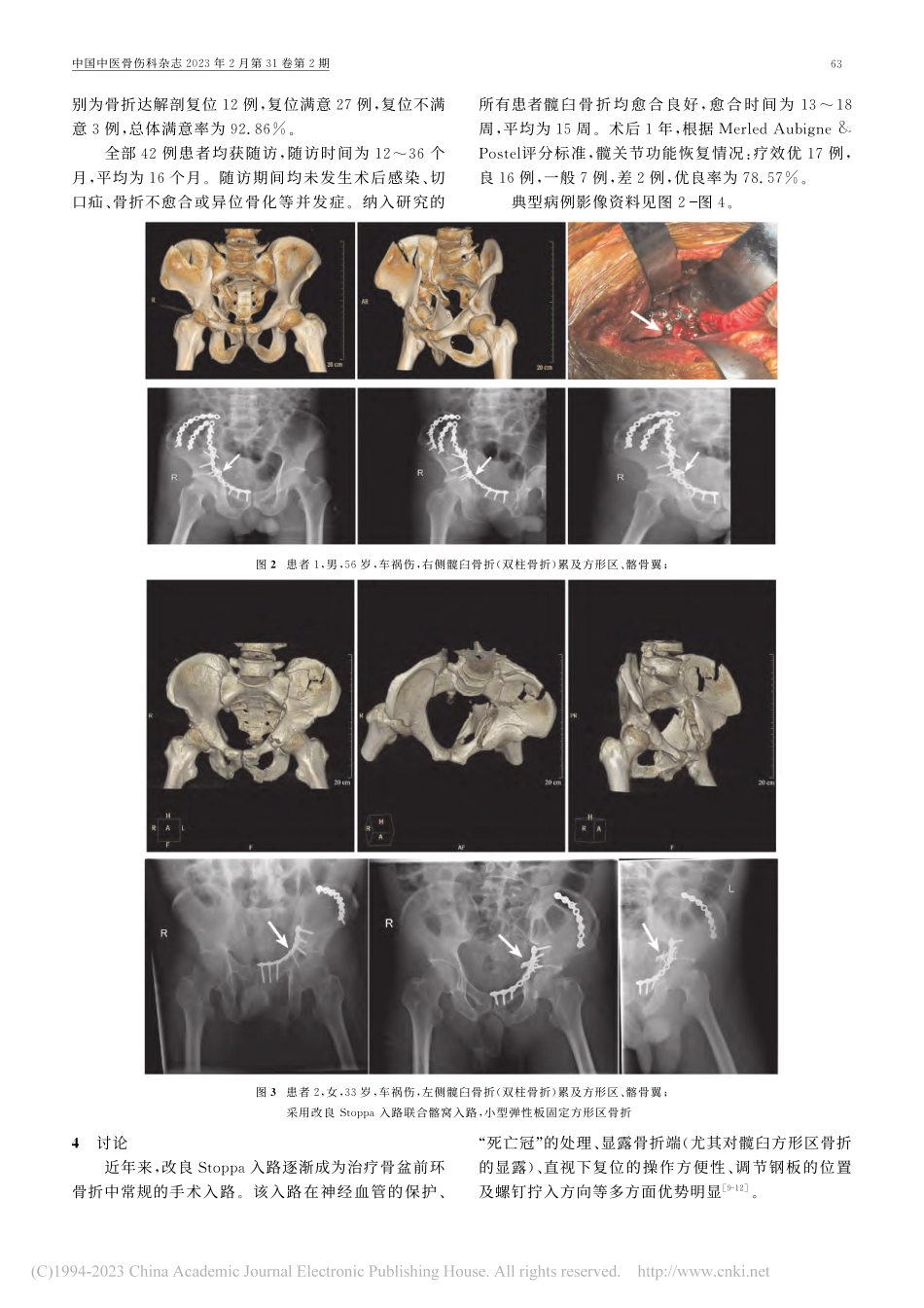 小型弹性板内固定治疗累及方形区的髋臼骨折42例_缪杰佳.pdf_第3页