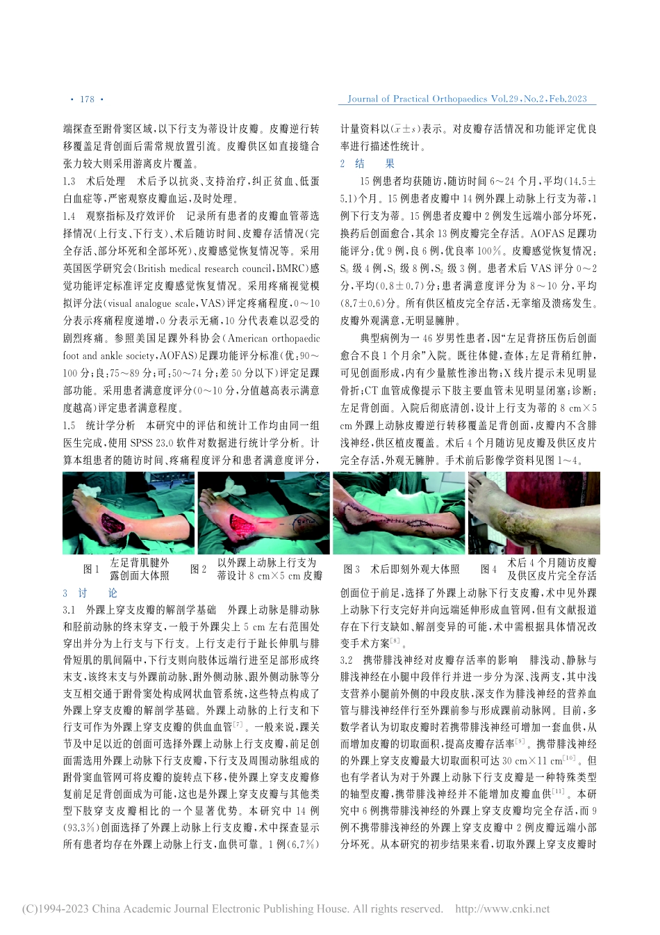外踝上穿支皮瓣逆行转移修复足背创面的疗效分析_顾松.pdf_第2页