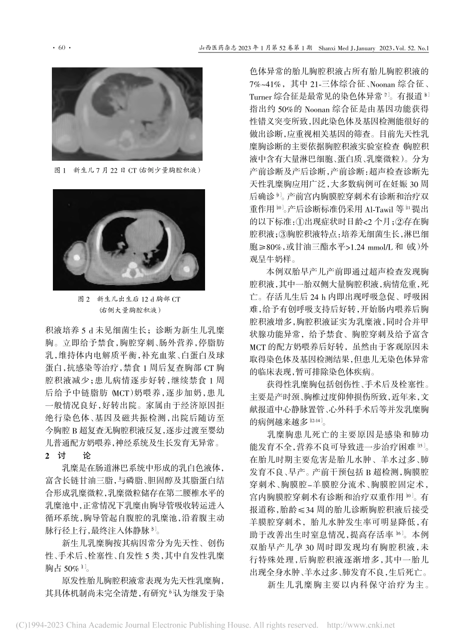 双胎早产儿乳糜胸1例并文献复习_丁媛媛.pdf_第2页