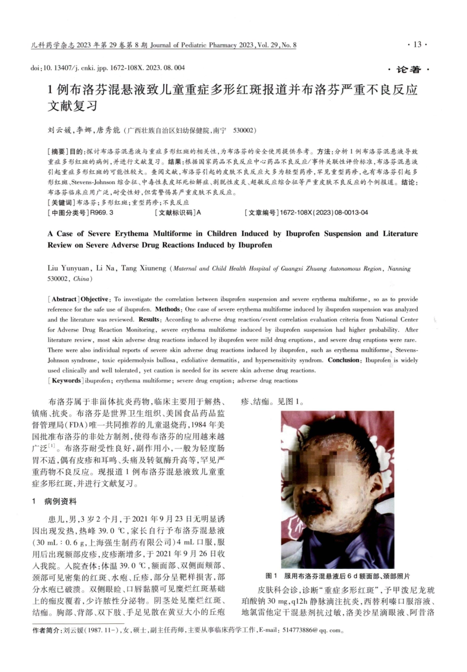 1例布洛芬混悬液致儿童重症多形红斑报道并布洛芬严重不良反应文献复习.pdf_第1页