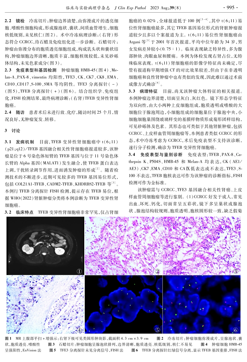 TFEB变异性肾细胞癌1例并文献复习.pdf_第2页