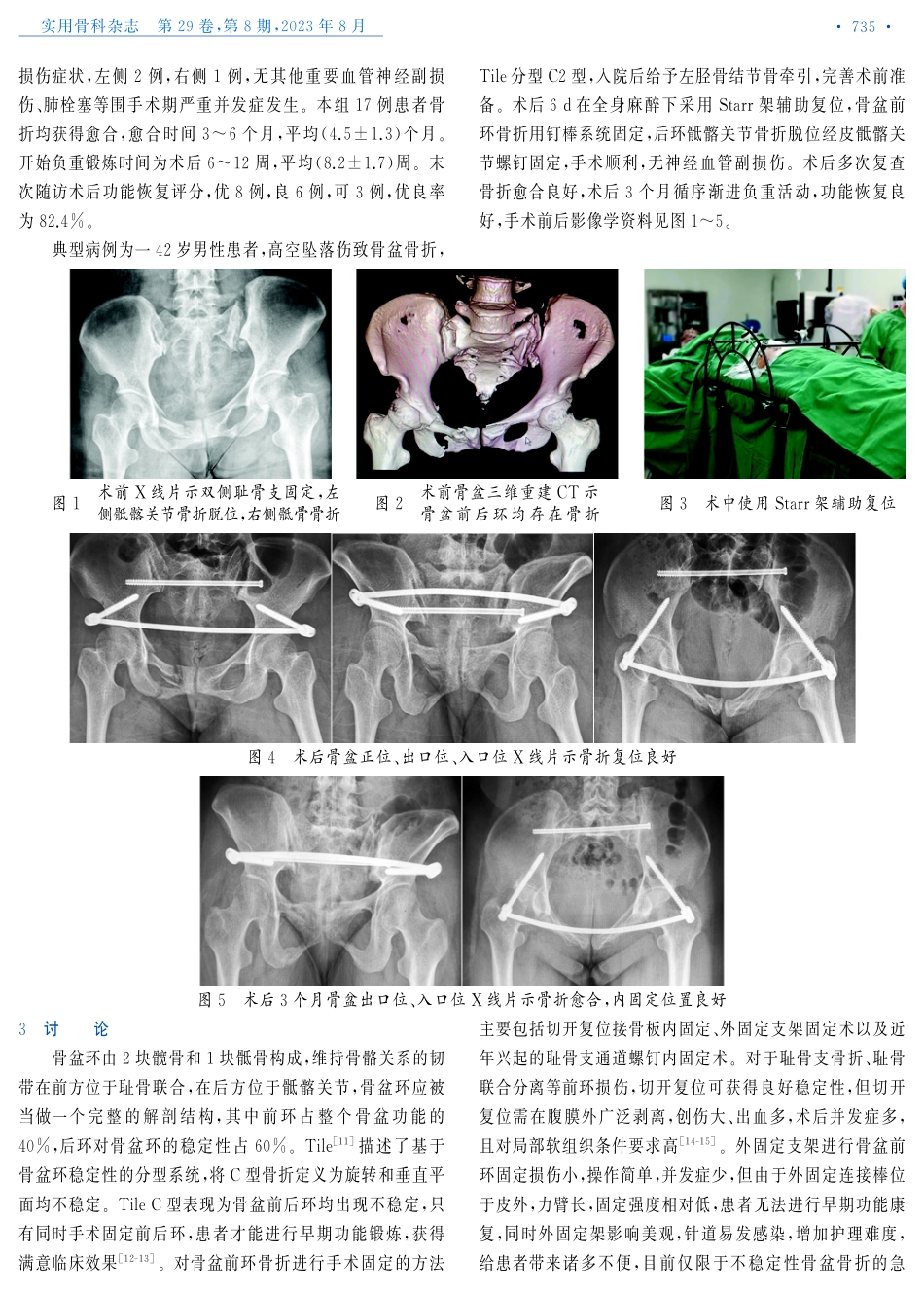 Starr架辅助复位下前环钉棒系统联合经皮骶髂关节螺钉治疗Tile C1-C2型骨盆骨折.pdf_第3页
