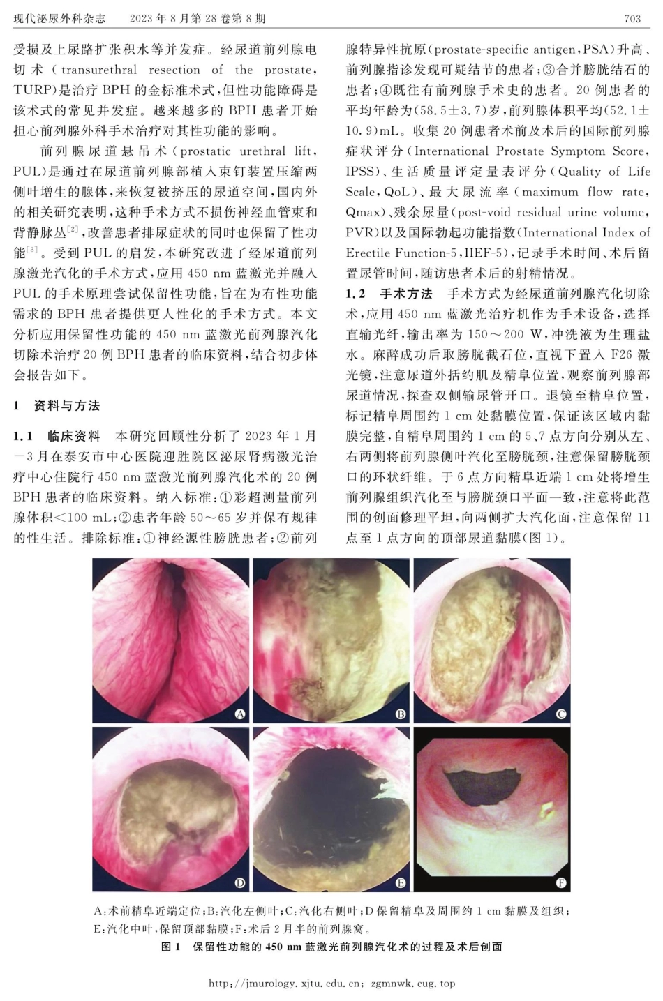保留性功能的450 nm蓝激光汽化术治疗前列腺增生症20例报告.pdf_第2页