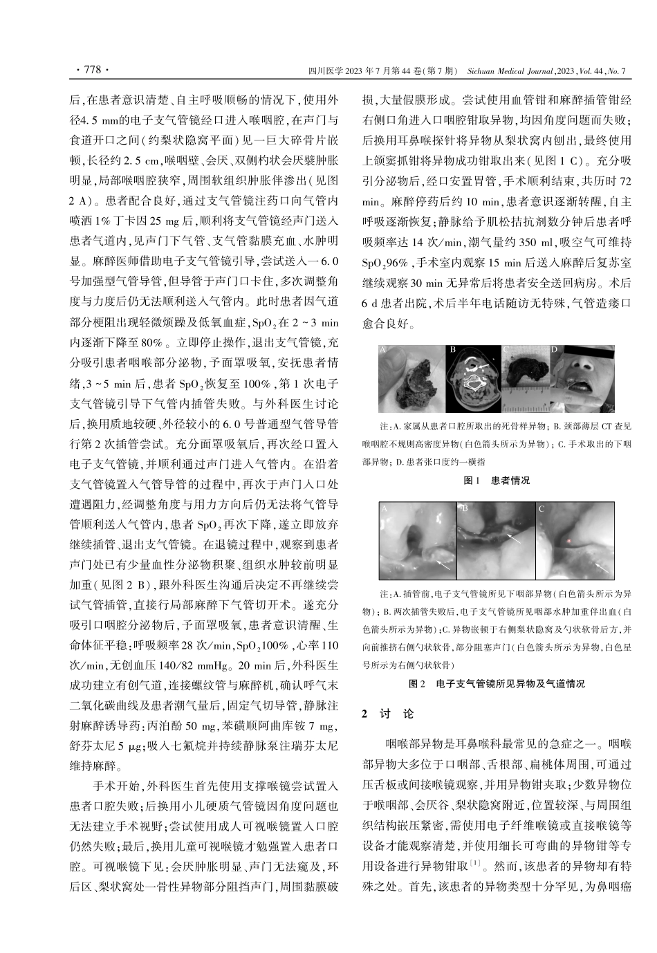 鼻咽癌患者急诊行下咽部异物钳取术的麻醉管理1例.pdf_第2页