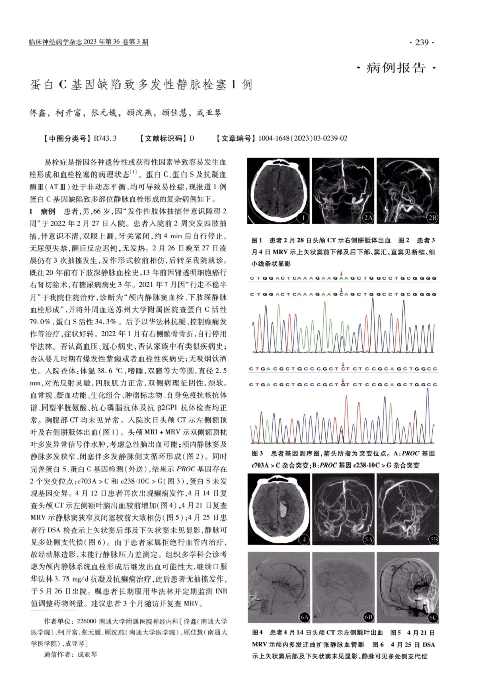 蛋白C基因缺陷致多发性静脉栓塞1例.pdf_第1页
